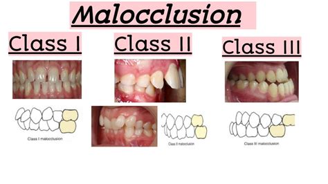 Difference between class II and class III Signature .